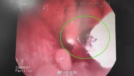 重庆女子咳嗽9个月治不好 竟是因吃火锅把辣椒呛进肺 (图1)